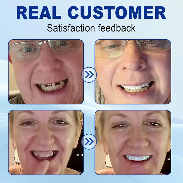 Nurbini™ Advanced Customized Full Denture Set 5 Nurbini™ Advanced Customized Full Denture Set