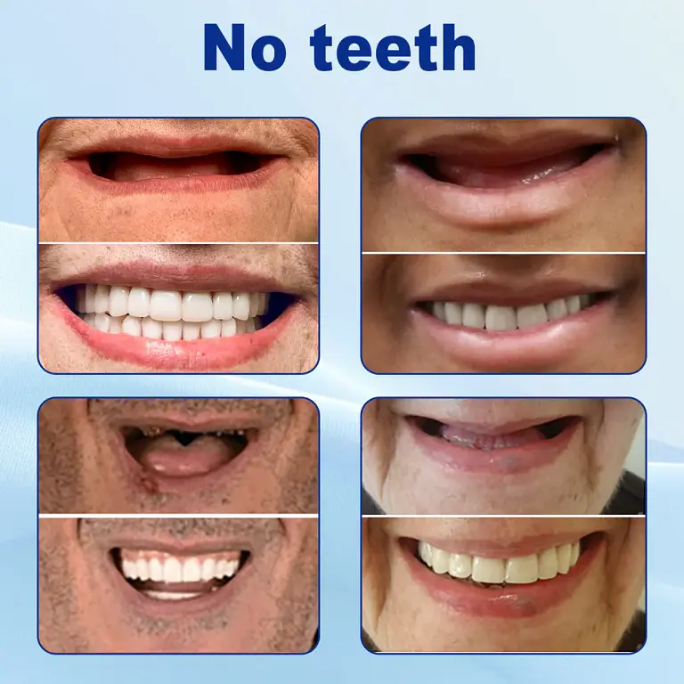 Nurbini™ Advanced Customized Full Denture Set 3 Nurbini™ Advanced Customized Full Denture Set