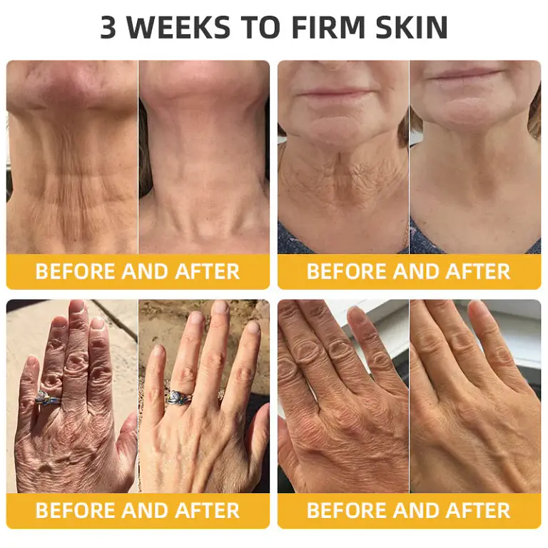 Turonu® Bee Venom Skin Remedy Cream 5 Turonu® Bee Venom Skin Remedy Cream