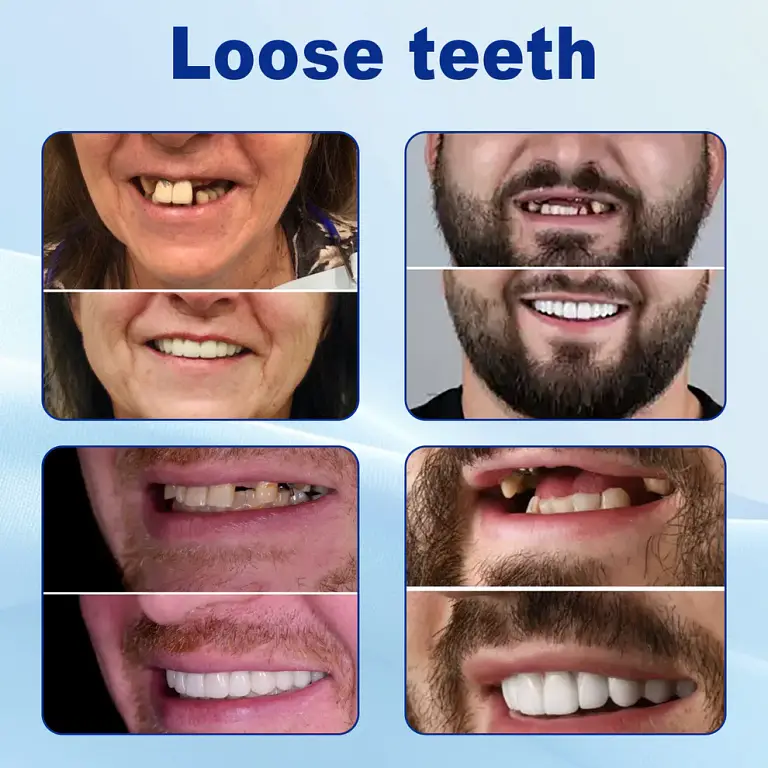 Nurbini™ Advanced Customized Full Denture Set 2 Nurbini™ Advanced Customized Full Denture Set