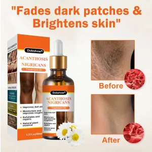 Dobshow® Acanthosis Nigricans Treatment Oil 12 Dobshow® Acanthosis Nigricans Treatment Oil