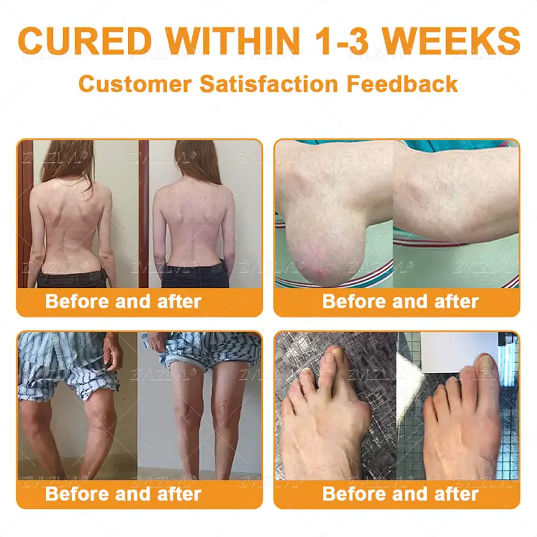 ZVLZVL® Bee Venom Pain-Relief Bone Healing Cream 11 ZVLZVL® Bee Venom Pain-Relief Bone Healing Cream