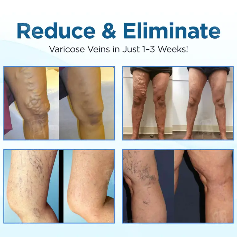 Cvreoz® Herbal Varicose Veins Treatment Spray 10 Cvreoz® Herbal Varicose Veins Treatment Spray