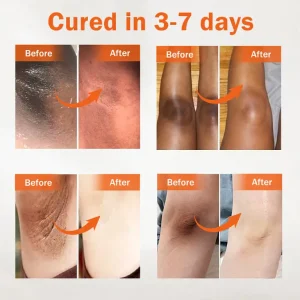 Dobshow® Acanthosis Nigricans Treatment Oil 20 Dobshow® Acanthosis Nigricans Treatment Oil