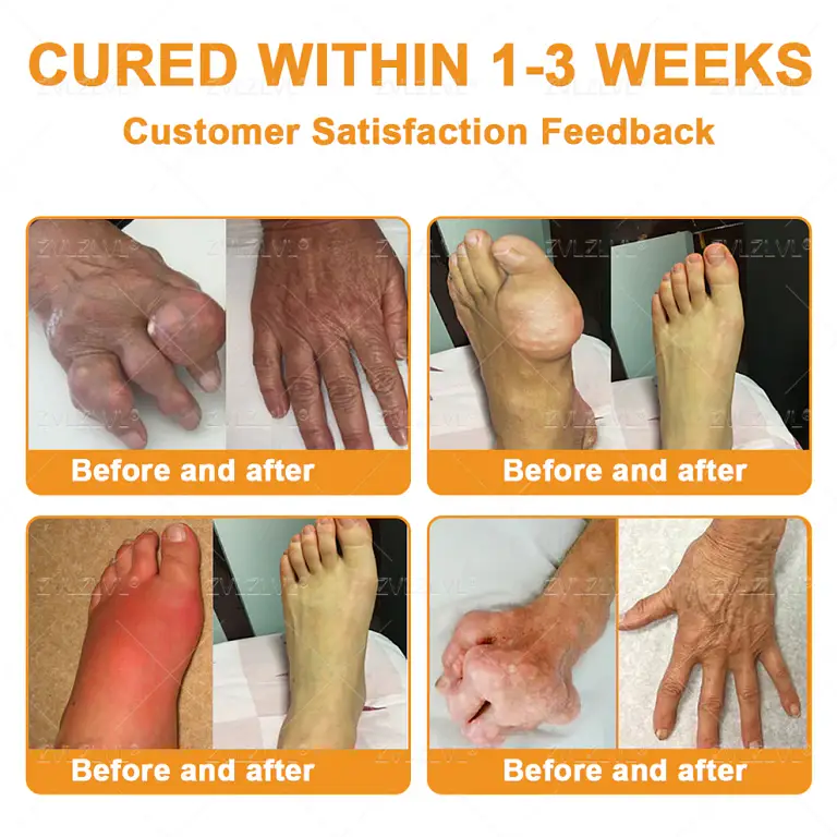 ZVLZVL® Bee Venom Pain-Relief Bone Healing Cream 10 ZVLZVL® Bee Venom Pain-Relief Bone Healing Cream