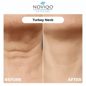 Noviqo™ – Anti-Wrinkle Freeze-Dried Nano-Silk Collagen System 11 Noviqo™ – Anti-Wrinkle Freeze-Dried Nano-Silk Collagen System