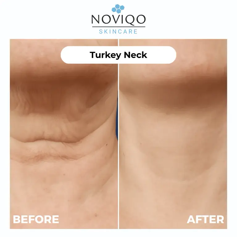 Noviqo™ – Anti-Wrinkle Freeze-Dried Nano-Silk Collagen System 5 Noviqo™ – Anti-Wrinkle Freeze-Dried Nano-Silk Collagen System