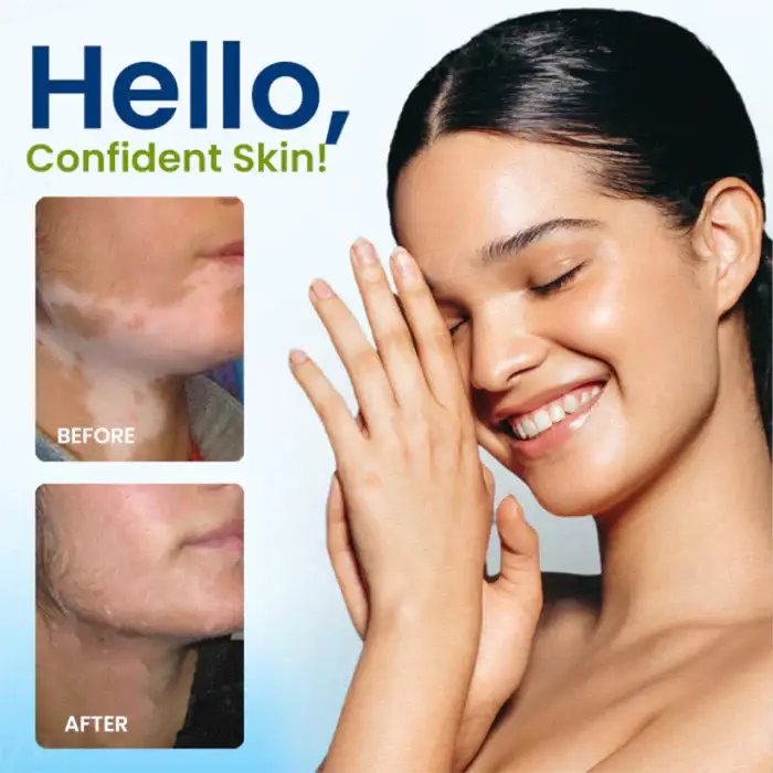 Cvreoz® Vitiligo Treatment Spray 9 Cvreoz® Vitiligo Treatment Spray