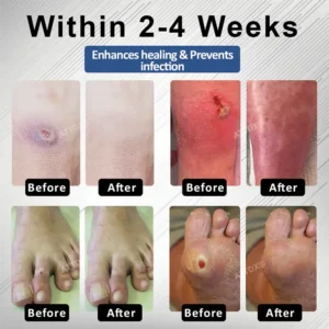 CVREOZ® Diabetes Foot Guard Fast Recovery Spray 19 CVREOZ® Diabetes Foot Guard Fast Recovery Spray