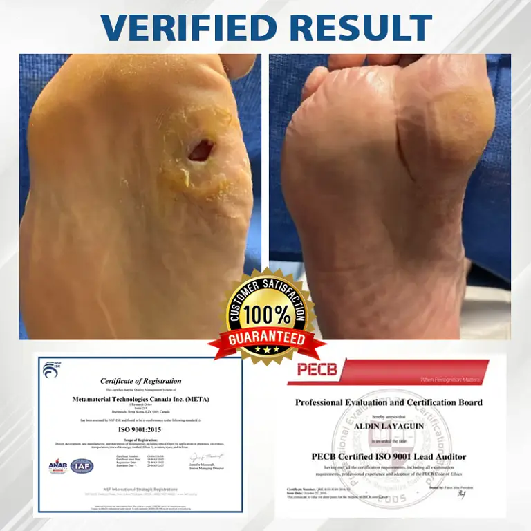 CVREOZ® Diabetes Foot Guard Fast Recovery Spray 10 CVREOZ® Diabetes Foot Guard Fast Recovery Spray