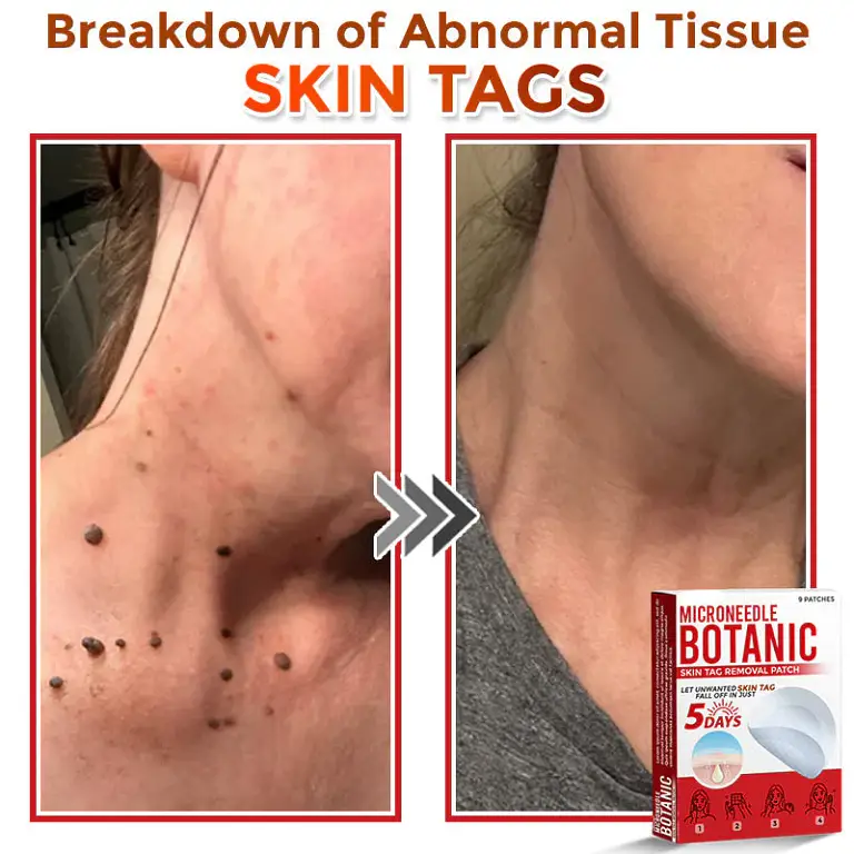 LOVILDS® MicroNeedle Botanic Skin Tag Removal Patch 2 LOVILDS® MicroNeedle Botanic Skin Tag Removal Patch