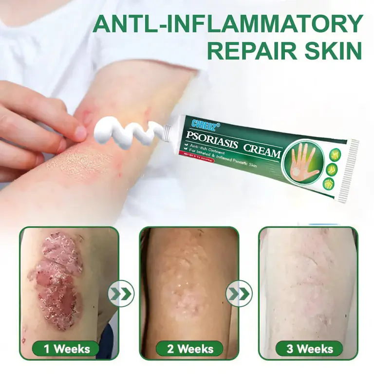 Cvreoz® Knotaway Psoriasis Cream 5 Cvreoz® Knotaway Psoriasis Cream