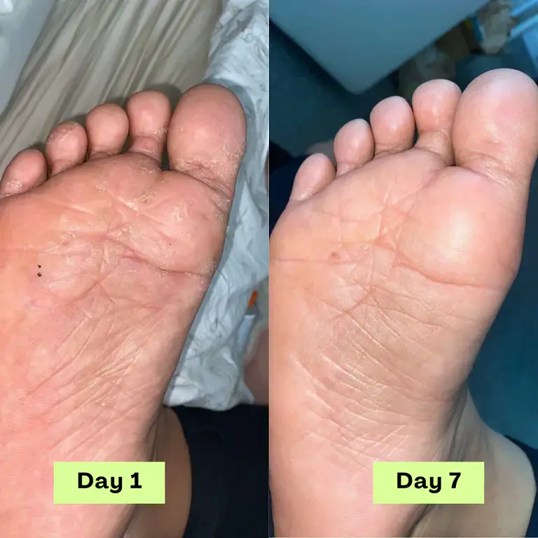 NEGUSY™ Tea Tree Athlete’s Foot Defense Soap 7 NEGUSY™ Tea Tree Athlete’s Foot Defense Soap