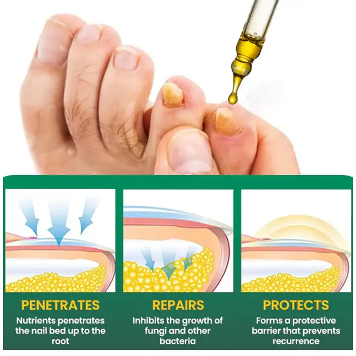 AEXZR® Fungal Nail Treatment 6 AEXZR® Fungal Nail Treatment