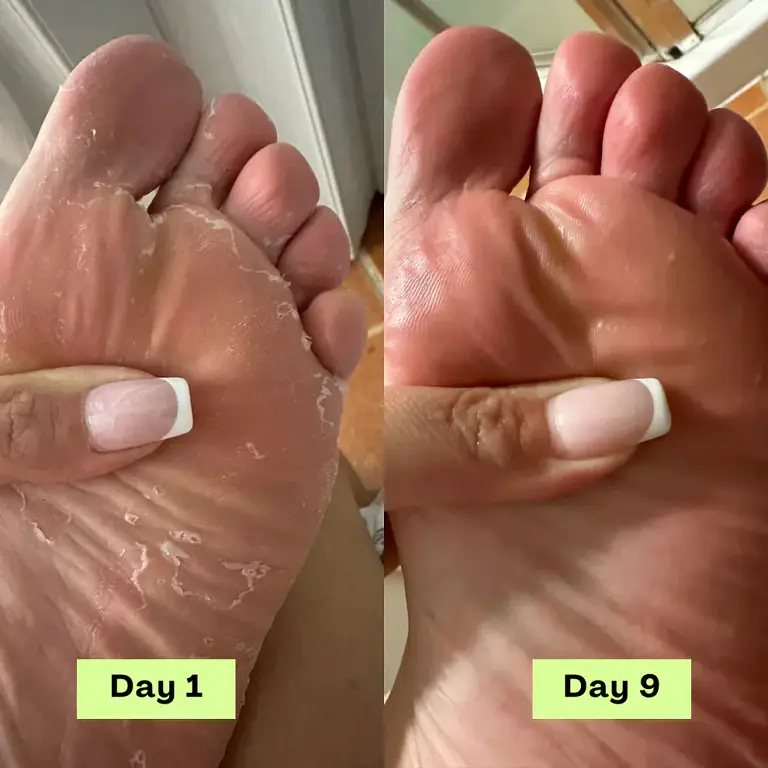 NEGUSY™ Tea Tree Athlete’s Foot Defense Soap 6 NEGUSY™ Tea Tree Athlete’s Foot Defense Soap