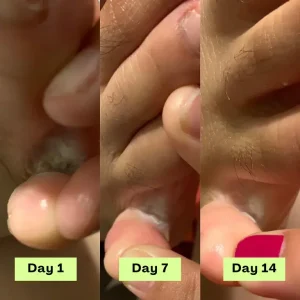 NEGUSY™ Tea Tree Athlete’s Foot Defense Soap 11 NEGUSY™ Tea Tree Athlete’s Foot Defense Soap