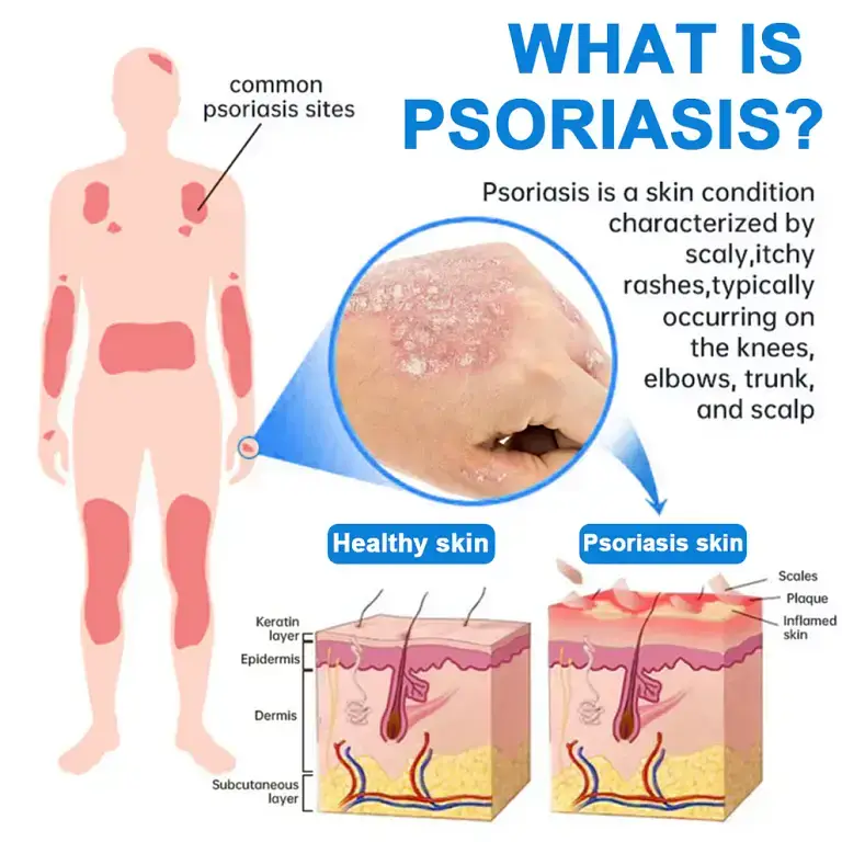 Zvoevo®Magnesium Herbal Psoriasis Spray 12 Zvoevo®Magnesium Herbal Psoriasis Spray