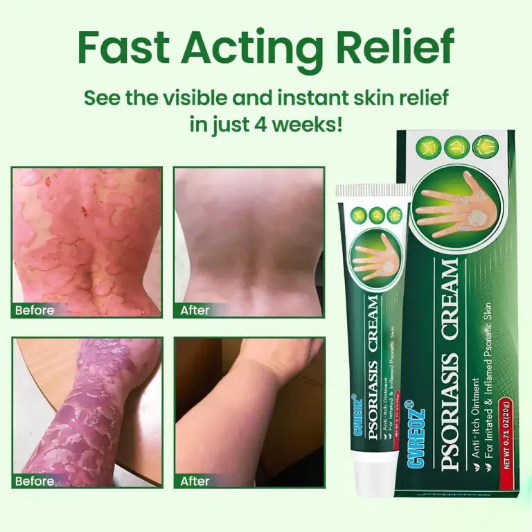 Cvreoz® Knotaway Psoriasis Cream 11 Cvreoz® Knotaway Psoriasis Cream