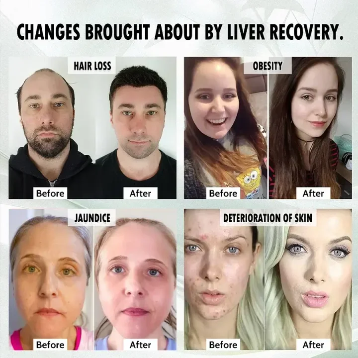 LiverPlus® FGF21 Liver Support Weight Loss Oral Solution 7 LiverPlus® FGF21 Liver Support Weight Loss Oral Solution