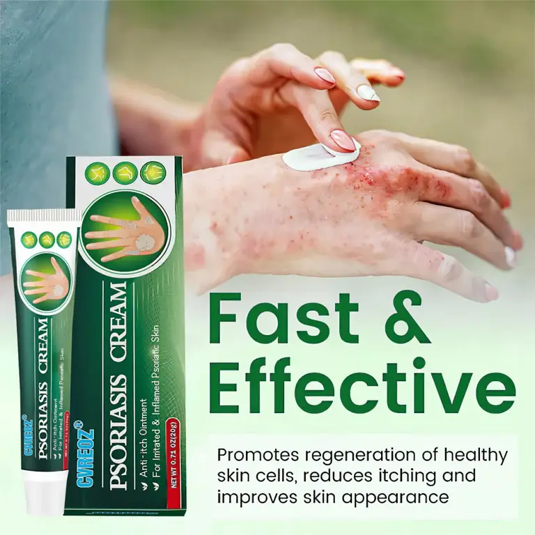 Cvreoz® Knotaway Psoriasis Cream 9 Cvreoz® Knotaway Psoriasis Cream