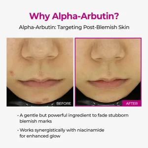 LUHAKA® Pore & Spot Care Duo 12 LUHAKA® Pore & Spot Care Duo