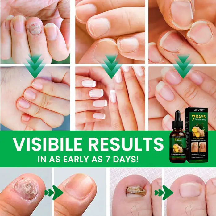 AEXZR® Fungal Nail Treatment 4 AEXZR® Fungal Nail Treatment