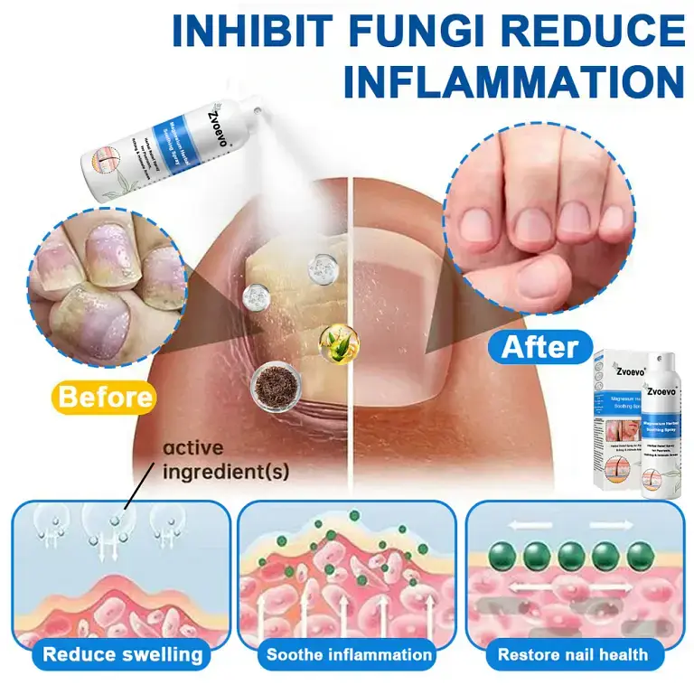 Zvoevo®Magnesium Herbal Psoriasis Spray 5 Zvoevo®Magnesium Herbal Psoriasis Spray