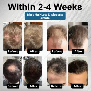 ATTDX® Hair Reawaken PP405 Roll-On Serum 8 ATTDX® Hair Reawaken PP405 Roll-On Serum