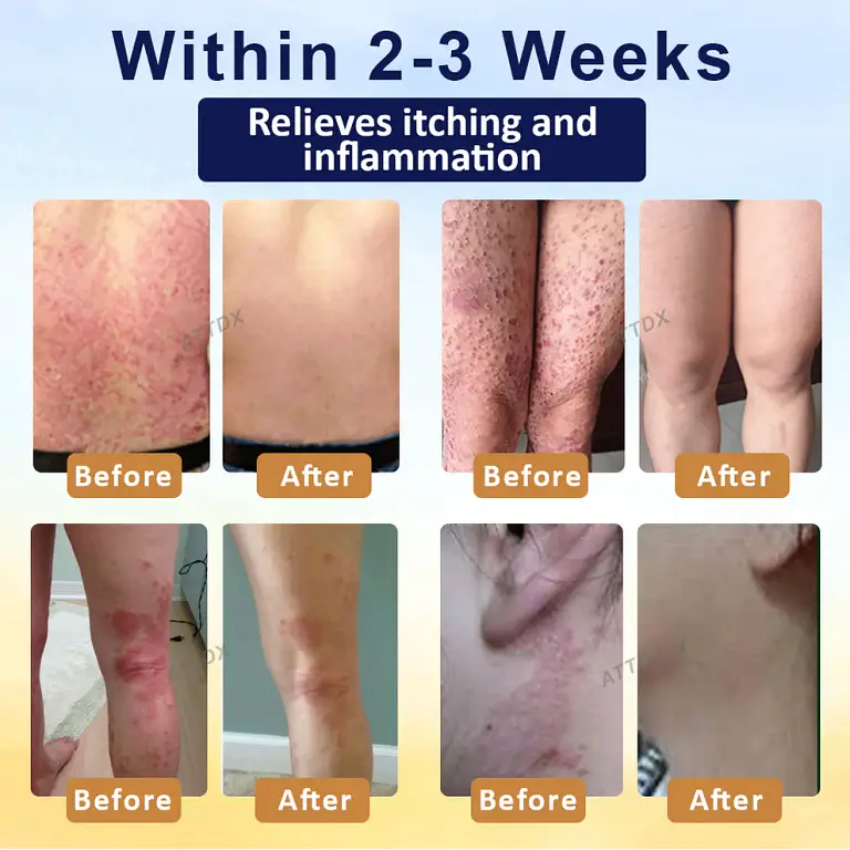 Croaie® PsoriasisCare Mellifera Venom Skin Healing Spray 4 Croaie® PsoriasisCare Mellifera Venom Skin Healing Spray