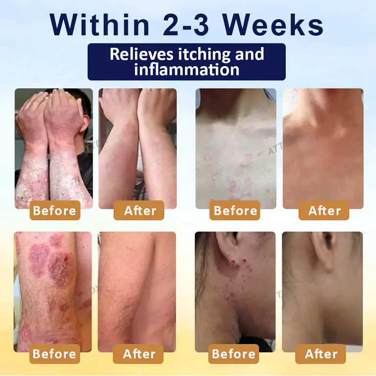 Croaie® PsoriasisCare Mellifera Venom Skin Healing Spray 3 Croaie® PsoriasisCare Mellifera Venom Skin Healing Spray