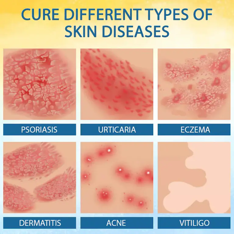 Croaie® PsoriasisCare Mellifera Venom Skin Healing Spray 6 Croaie® PsoriasisCare Mellifera Venom Skin Healing Spray