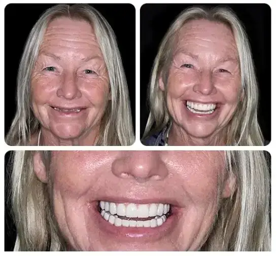 BQYOOM™-Custom-Fit Functional Dentures — Combination pack 5 BQYOOM™-Custom-Fit Functional Dentures — Combination pack