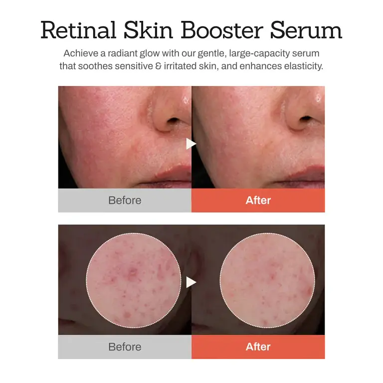 NESLEMY™Retinal Skin Booster Serum 2 NESLEMY™Retinal Skin Booster Serum