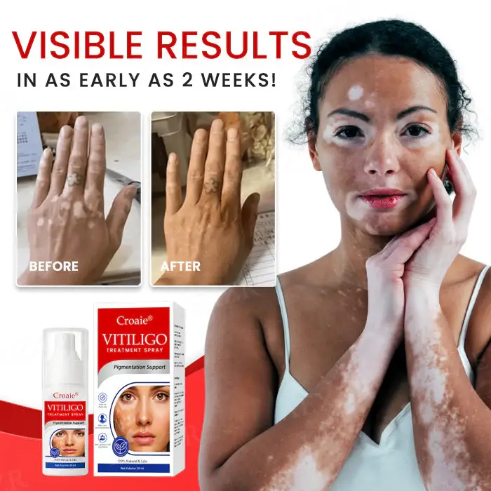 Croaie® Vitiligo Treatment Spray – No allergies 2 Croaie® Vitiligo Treatment Spray – No allergies