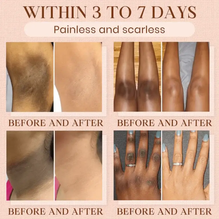 Luhaka®️ Purifying Exfoliating Gel for Acanthosis Nigricans 3 Luhaka®️ Purifying Exfoliating Gel for Acanthosis Nigricans