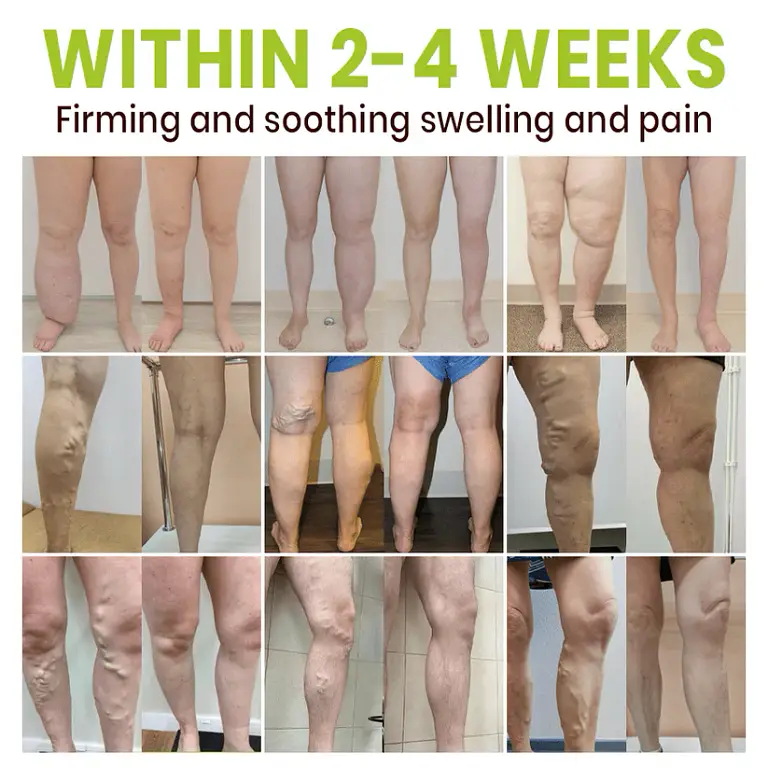 Lyyeto® Professional Leg Circulation Cream 5 Lyyeto® Professional Leg Circulation Cream