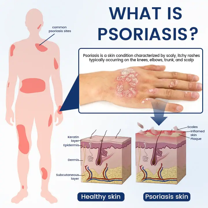 Timilk® PsoriCure Magnesium Herbal Spray 5 Timilk® PsoriCure Magnesium Herbal Spray