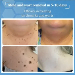 Zvoevo® BeeDerm RX Cream, Painless, Targeted Treatment for Warts 9 Zvoevo® BeeDerm RX Cream, Painless, Targeted Treatment for Warts