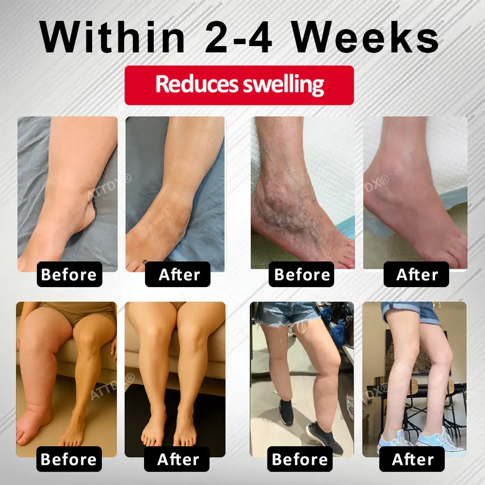 ATTDX® Advanced CVI Edema Therapy Cream 4 ATTDX® Advanced CVI Edema Therapy Cream