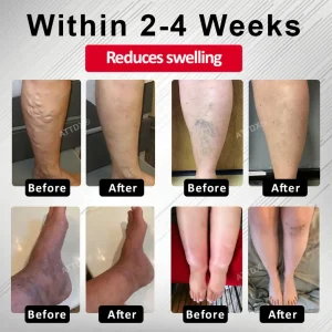 ATTDX® Advanced CVI Edema Therapy Cream 7 ATTDX® Advanced CVI Edema Therapy Cream