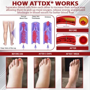 ATTDX® Advanced CVI Edema Therapy Cream 6 ATTDX® Advanced CVI Edema Therapy Cream