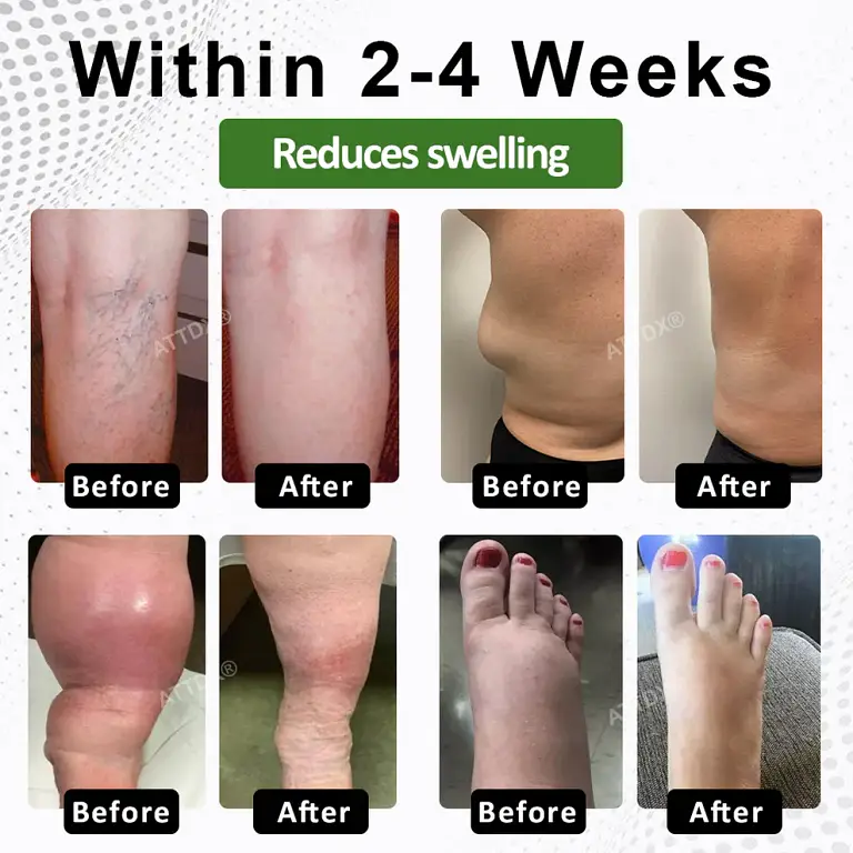 ATTDX® LymphoHerb Edema Support Capsules 3 ATTDX® LymphoHerb Edema Support Capsules