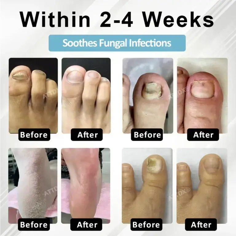 ATTDX® MycoStop Nail Recovery Serum Pen 4 ATTDX® MycoStop Nail Recovery Serum Pen