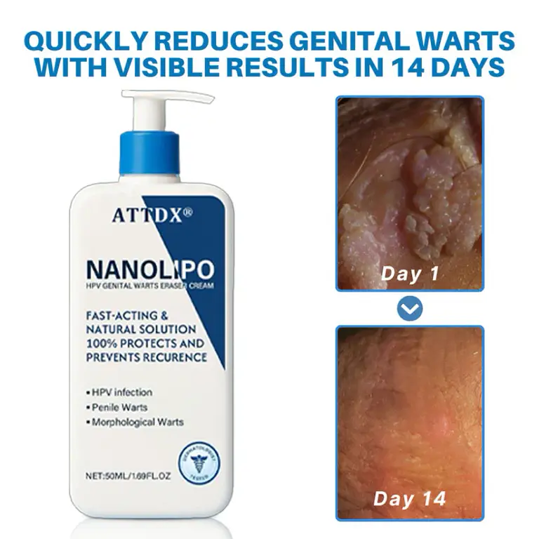 ATTDX® NanoLipo HPV Genital Warts Eraser Cream 4 ATTDX® NanoLipo HPV Genital Warts Eraser Cream