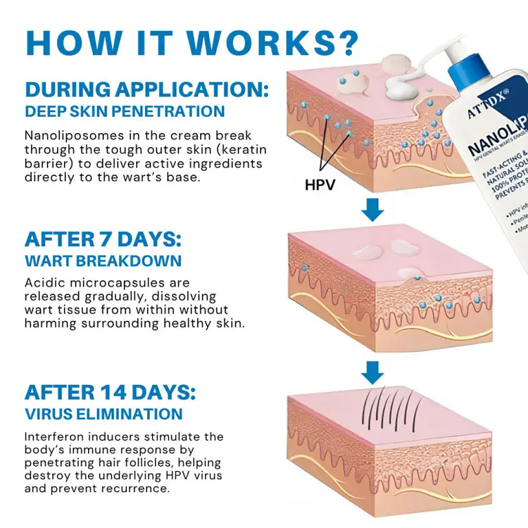 ATTDX® NanoLipo HPV Genital Warts Eraser Cream 3 ATTDX® NanoLipo HPV Genital Warts Eraser Cream