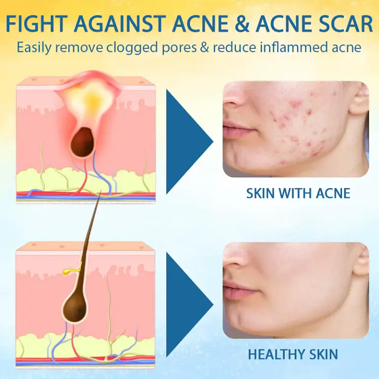 LOVILDS™ Psoriasis Care Mellifera Venom Skin Healing Spray 5 LOVILDS™ Psoriasis Care Mellifera Venom Skin Healing Spray