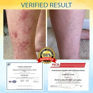 LOVILDS™ Psoriasis Care Mellifera Venom Skin Healing Spray 8 LOVILDS™ Psoriasis Care Mellifera Venom Skin Healing Spray