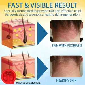 LOVILDS™ Psoriasis Care Mellifera Venom Skin Healing Spray 7 LOVILDS™ Psoriasis Care Mellifera Venom Skin Healing Spray