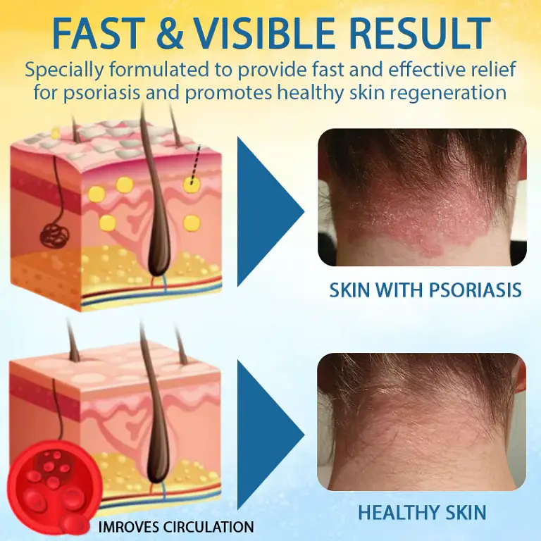 LOVILDS™ Psoriasis Care Mellifera Venom Skin Healing Spray 3 LOVILDS™ Psoriasis Care Mellifera Venom Skin Healing Spray