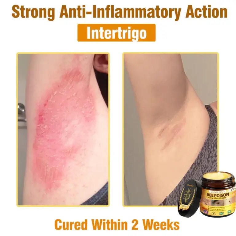 LOVILDS™ Bee Poison All-in-One Cream 2 LOVILDS™ Bee Poison All-in-One Cream